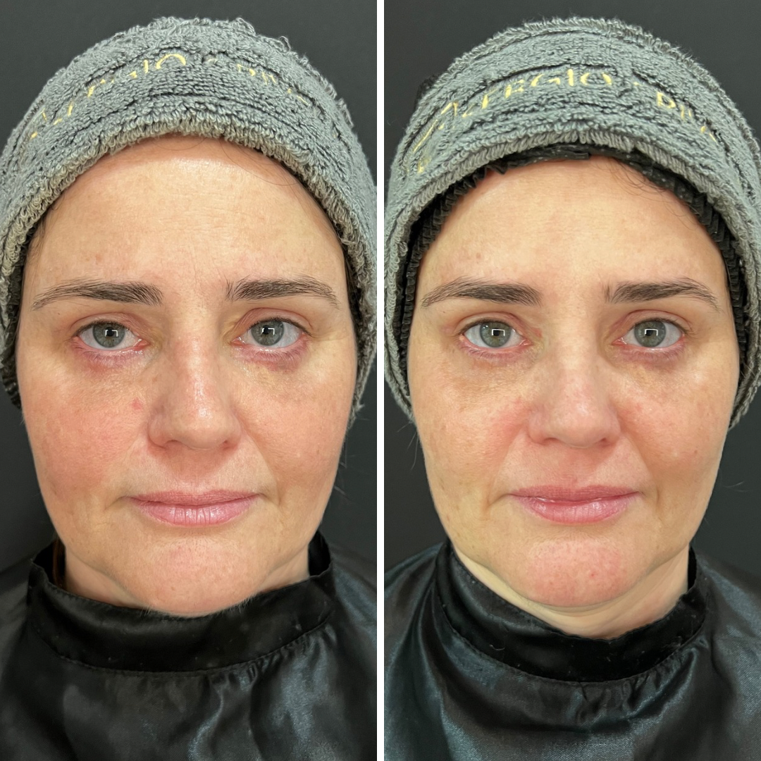 Cópia de Nemora Argentin Braga - botox - 1